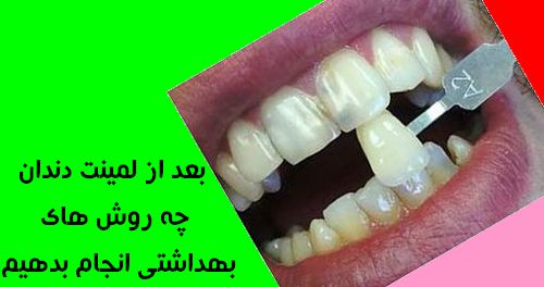 بعد از لمینت دندان چه روش های بهداشتی انجام بدهیم 